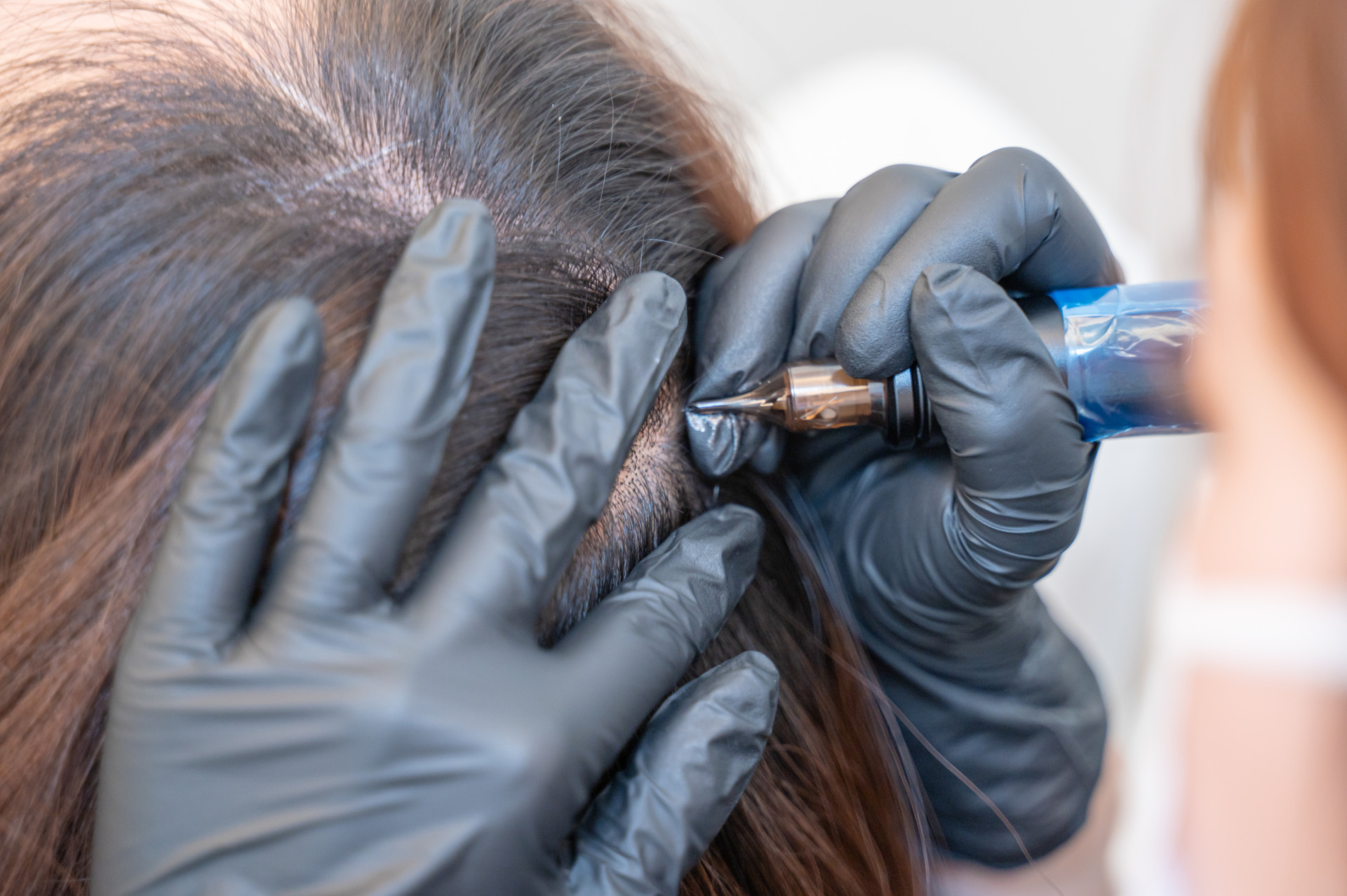 頭皮アートメイク